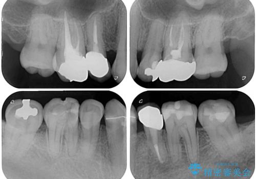 むし歯や銀歯が気になる　後戻りの再矯正治療とむし歯治療の治療前