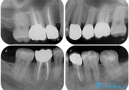 むし歯や銀歯が気になる　後戻りの再矯正治療とむし歯治療の治療後