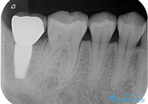 セラミックインレーによる治療の治療後