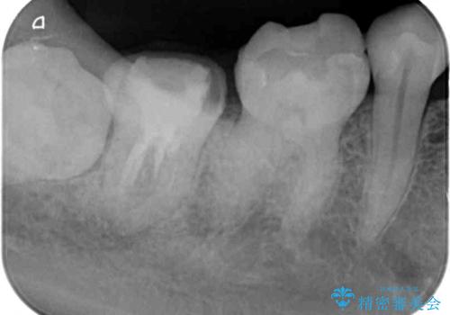 セラミックは無理と言われた奥歯 フルジルコニアクラウンによる補綴治療の治療前