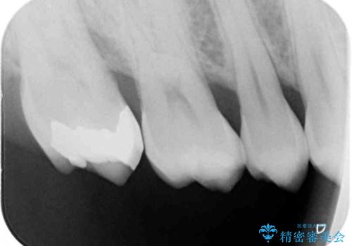 強い咬合力で生じた亀裂からむし歯に 奥歯のゴールドインレー治療の治療後