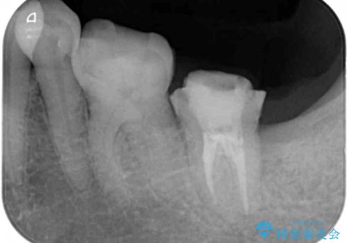 セラミックは無理と言われた奥歯 フルジルコニアクラウンによる補綴治療の治療前