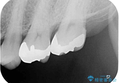 強い咬合力で生じた亀裂からむし歯に 奥歯のゴールドインレー治療の治療後