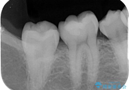 奥歯の深い虫歯の治療前
