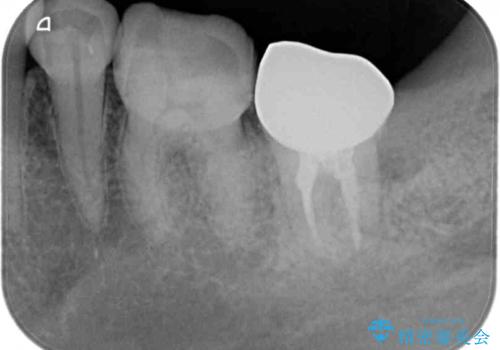 セラミックは無理と言われた奥歯 フルジルコニアクラウンによる補綴治療の治療後