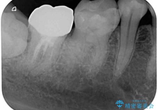 セラミックは無理と言われた奥歯 フルジルコニアクラウンによる補綴治療の治療後