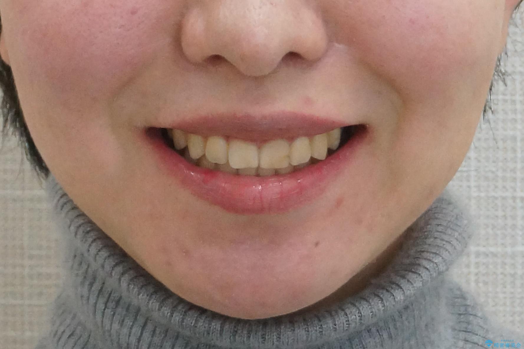 前歯のがたつき　ガミースマイルの改善の治療後（顔貌）