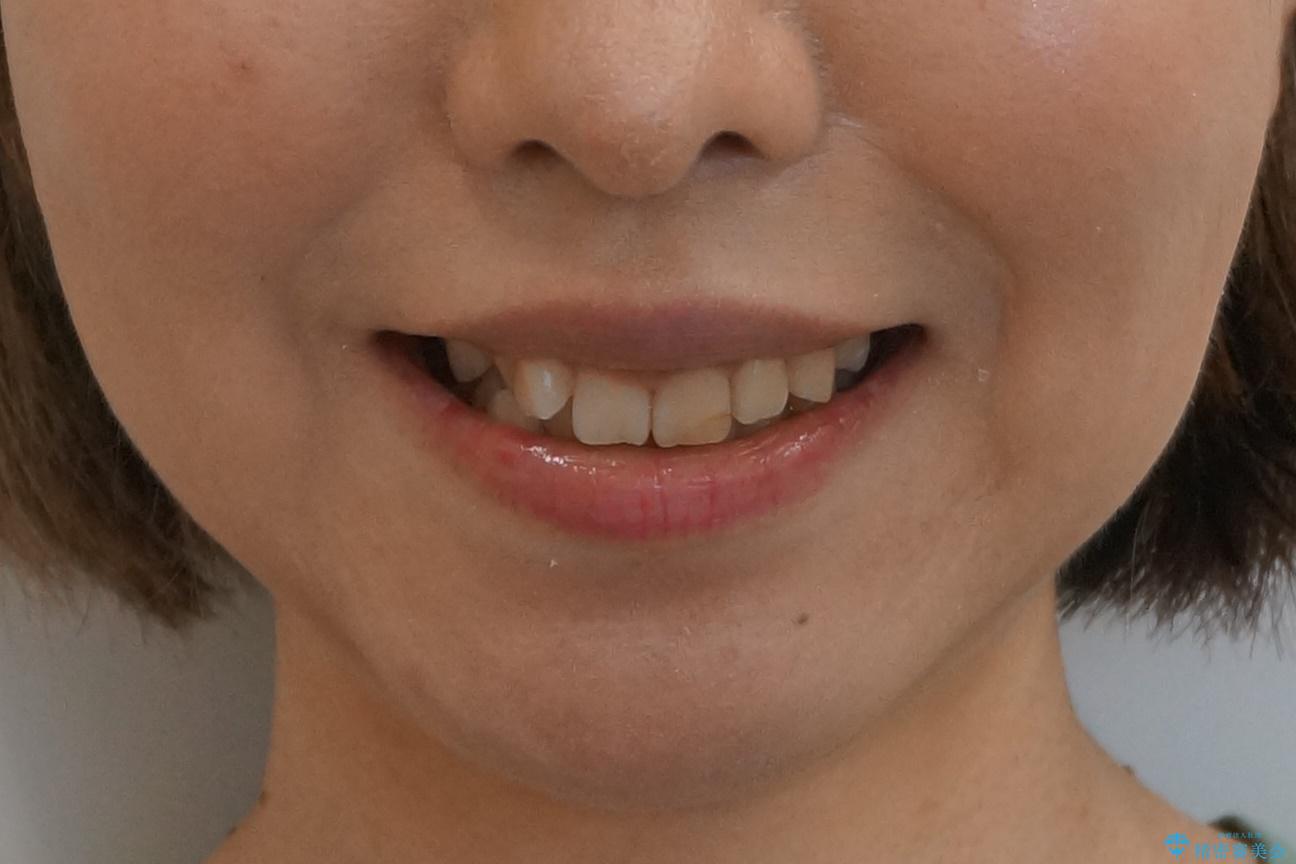 前歯のがたつき　ガミースマイルの改善の治療前（顔貌）