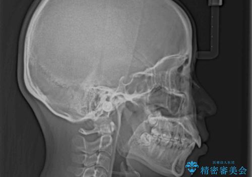 上顎前突　目立たないワイヤー装置での抜歯矯正の治療前