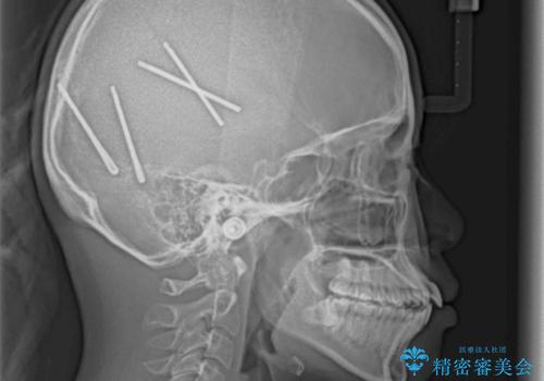 短期間で口元の突出感を改善 ワイヤー装置での抜歯矯正の治療前