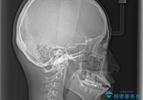 上下の出っ歯を治したい ワイヤー装置による抜歯矯正の治療前
