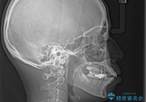 口元の突出感改善 なるべく銀歯を抜歯してワイヤー矯正の治療前