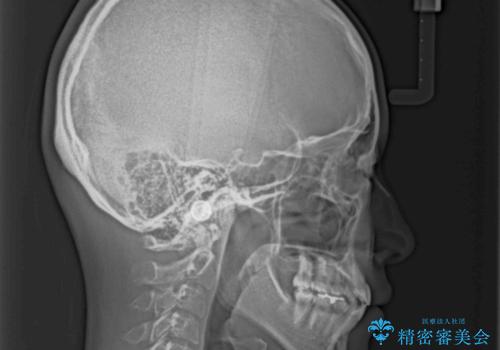 上下の出っ歯を治したい ワイヤー装置による抜歯矯正の治療後