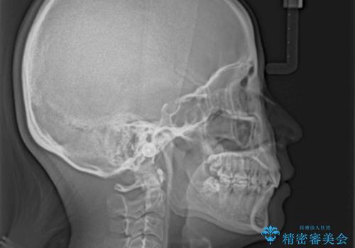 上顎前突 目立たないワイヤー装置での抜歯矯正の治療後