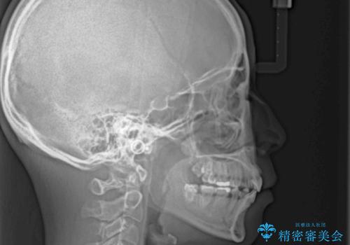 口元の突出感改善　なるべく銀歯を抜歯してワイヤー矯正の治療後