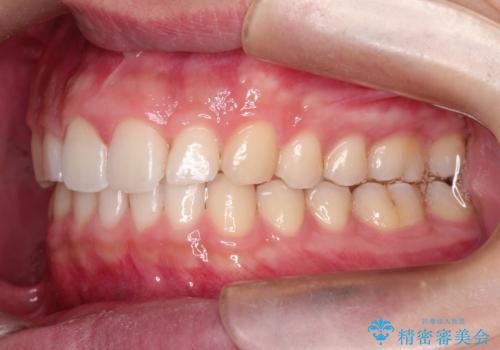 【過蓋咬合・正中離開・奥歯のズレでお悩みの方必見】非抜歯矯正症例(顎骨の成長を利用)の治療後
