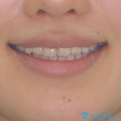 前歯の捻れを改善　インビザラインによる矯正治療の治療後（顔貌）