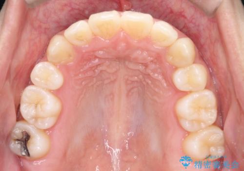 【八重歯・重度のがたつきでお悩みの方必見】抜歯矯正症例(審美ワイヤー矯正)の治療後