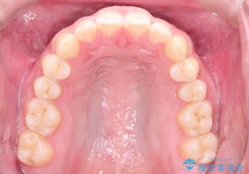 【過蓋咬合・正中離開・奥歯のズレでお悩みの方必見】非抜歯矯正症例(顎骨の成長を利用)の治療後