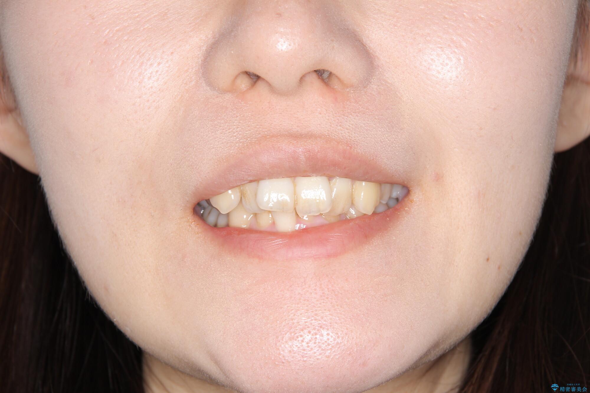 【がたつき・深い噛み合わせでお悩みの方必見】抜歯矯正症例(審美ワイヤー矯正)の治療前(顔貌)