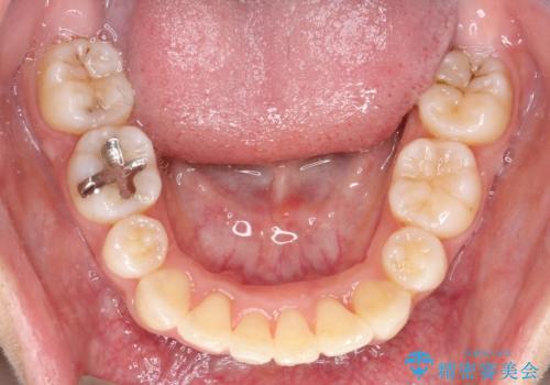 【八重歯・重度のがたつきでお悩みの方必見】抜歯矯正症例(審美ワイヤー矯正)の治療後