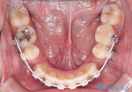 【八重歯・がたつきでお悩みの方必見】抜歯矯正症例(審美ワイヤー矯正)の治療中
