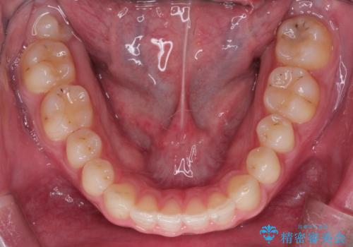 【過蓋咬合・正中離開・奥歯のズレでお悩みの方必見】非抜歯矯正症例(顎骨の成長を利用)の治療後