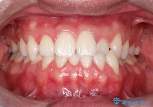 初めてのオフィスホワイトニングの治療後