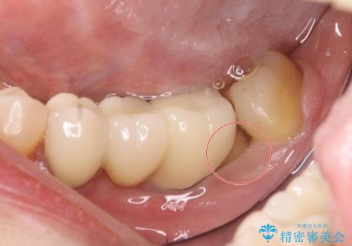 部分矯正してからオールセラミックブリッジの治療前