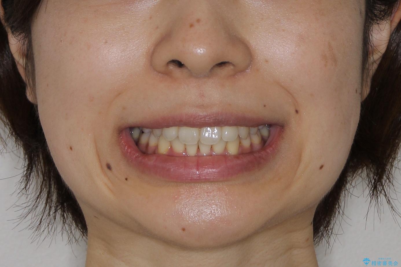 【八重歯・重度のがたつきでお悩みの方必見】抜歯矯正症例(審美ワイヤー矯正)の治療後(顔貌)