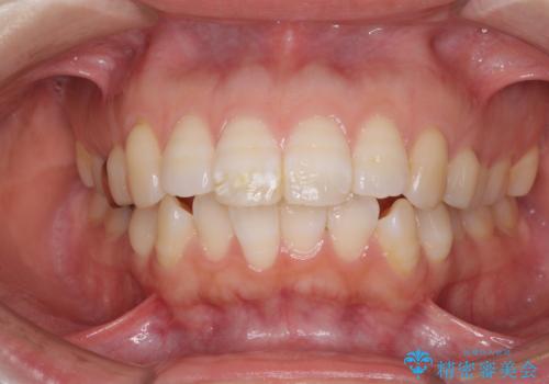 口元の突出感改善　なるべく銀歯を抜歯してワイヤー矯正の症例 治療前
