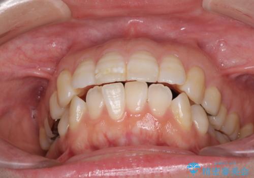 口元の突出感改善　なるべく銀歯を抜歯してワイヤー矯正の治療前