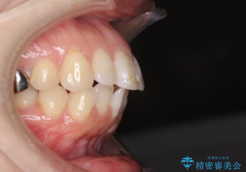 口元の突出感改善 なるべく銀歯を抜歯してワイヤー矯正の治療前