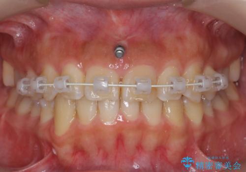 前歯のがたつき ガミースマイルの改善の治療中