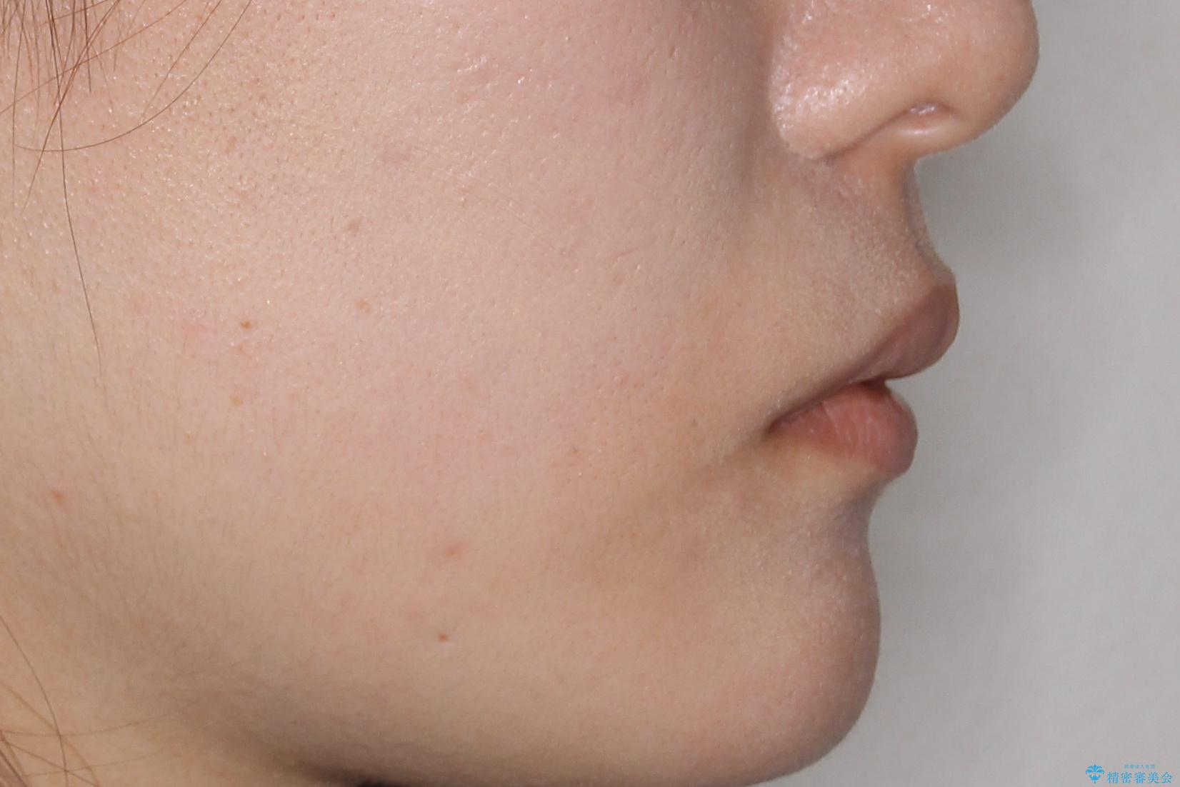 【がたつき・深い噛み合わせでお悩みの方必見】抜歯矯正症例(審美ワイヤー矯正)の治療前(顔貌)