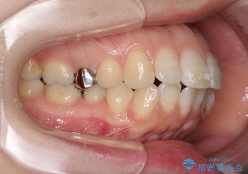 口元の突出感改善 なるべく銀歯を抜歯してワイヤー矯正の治療前