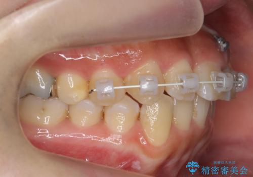 前歯のがたつき ガミースマイルの改善の治療中