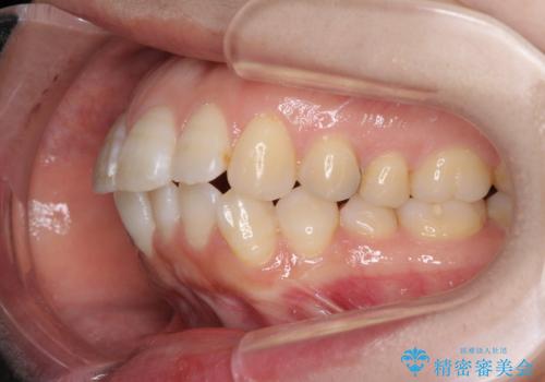 口元の突出感改善　なるべく銀歯を抜歯してワイヤー矯正の治療前