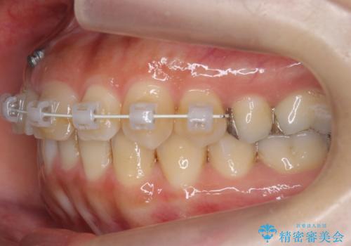 前歯のがたつき ガミースマイルの改善の治療中