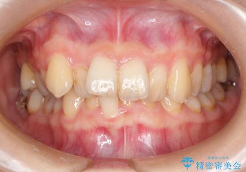 【がたつき・深い噛み合わせでお悩みの方必見】抜歯矯正症例(審美ワイヤー矯正)の治療前