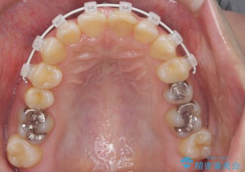 前歯のがたつき ガミースマイルの改善の治療中