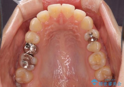 口元の突出感改善 なるべく銀歯を抜歯してワイヤー矯正の治療前
