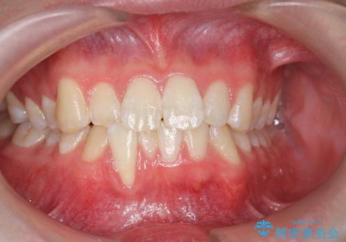 クロスバイト・歯並びが原因の歯肉退縮歯、矯正治療による審美性の改善の症例 治療前