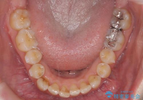前歯のがたつき ガミースマイルの改善の治療中
