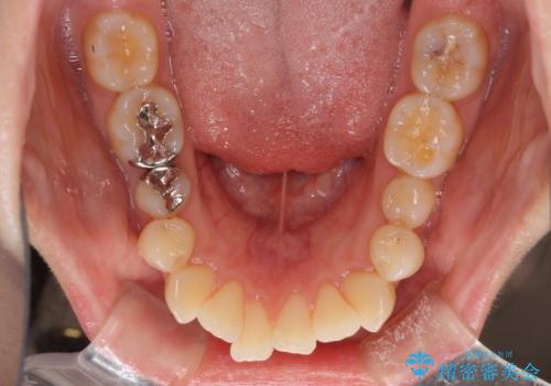 口元の突出感改善 なるべく銀歯を抜歯してワイヤー矯正の治療前