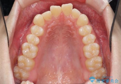 クロスバイト・歯並びが原因の歯肉退縮歯、矯正治療による審美性の改善の治療前