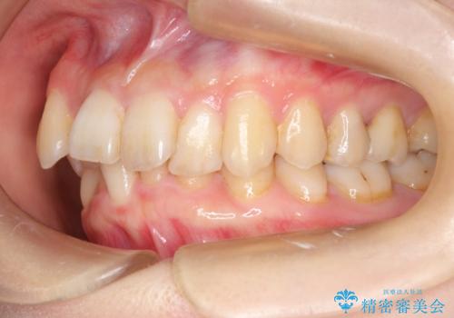 【がたつき・深い噛み合わせでお悩みの方必見】抜歯矯正症例(審美ワイヤー矯正)の治療前