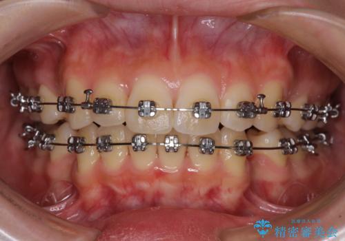 短期間で口元の突出感を改善 ワイヤー装置での抜歯矯正の治療中