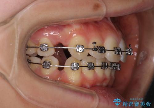 短期間で口元の突出感を改善 ワイヤー装置での抜歯矯正の治療中