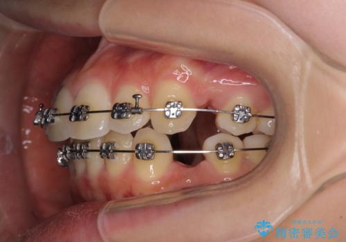短期間で口元の突出感を改善 ワイヤー装置での抜歯矯正の治療中
